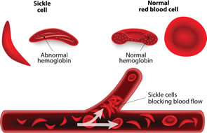 Pain Relief for Sickle Cell Patients